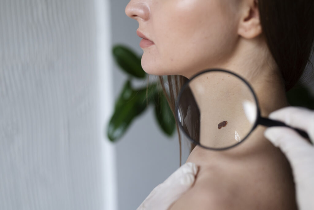 mulher com melanoma no pescoço